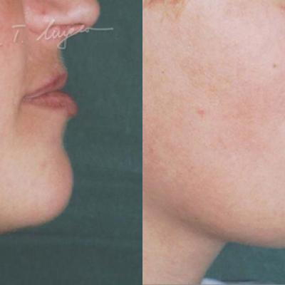 Marire Buze Adipoimplant 3
