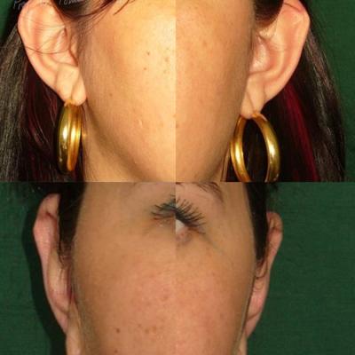 Otoplastia 2 1