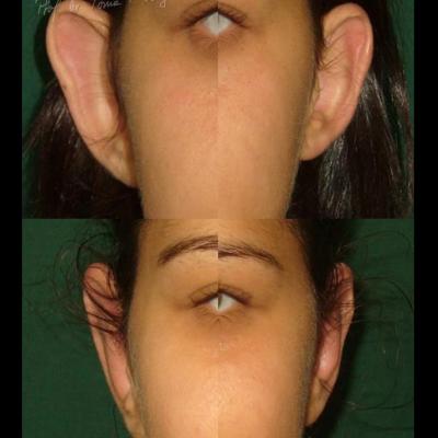 Otoplastia 4