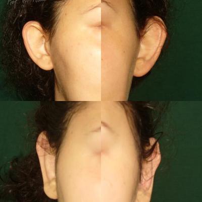Otoplastia