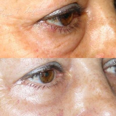 Blefaroplastie Inferioara 30zile 1