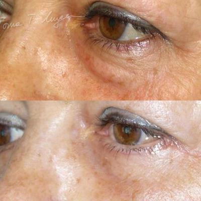Blefaroplastie Inferioara 30zile 2