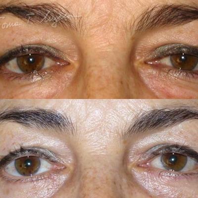Blefaroplastie Inferioara 30zile