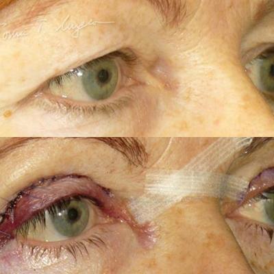 Blefaroplastie Superioara 24h 1