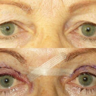 Blefaroplastie Superioara 24h 2