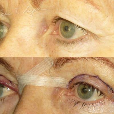 Blefaroplastie Superioara 24h