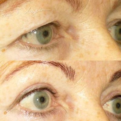 Blefaroplastie Superioara 30zile 1