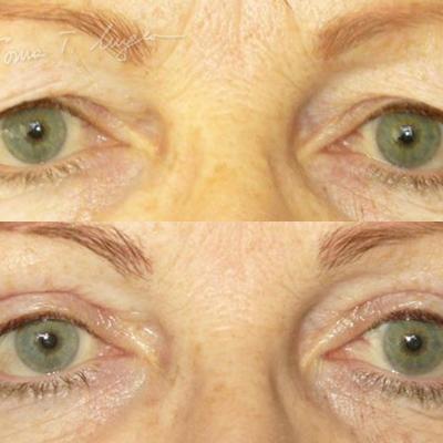 Blefaroplastie Superioara 30zile 2
