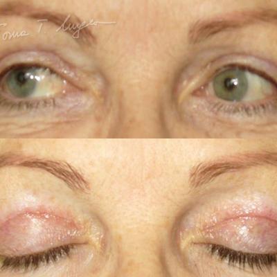 Blefaroplastie Superioara 30zile 3