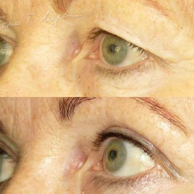 Blefaroplastie Superioara 30zile
