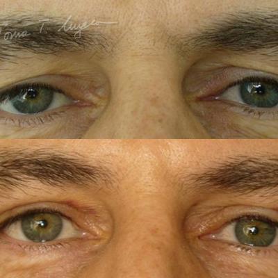 Blefaroplastie Superioara 5zile