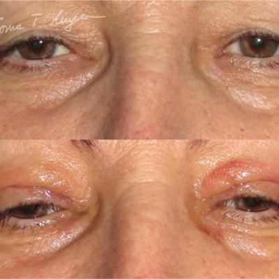 Blefaroplastie1