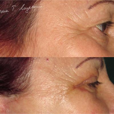 Blefaroplastie2