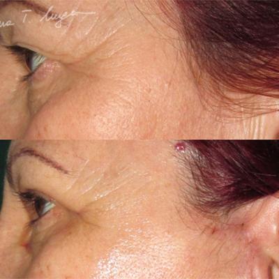 Blefaroplastie3
