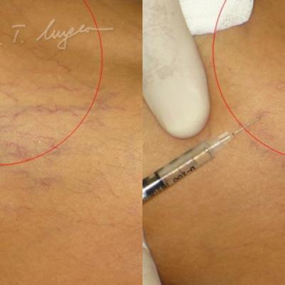 Venectazii Intradermice Injectarea De Solutii Sclerozante 1