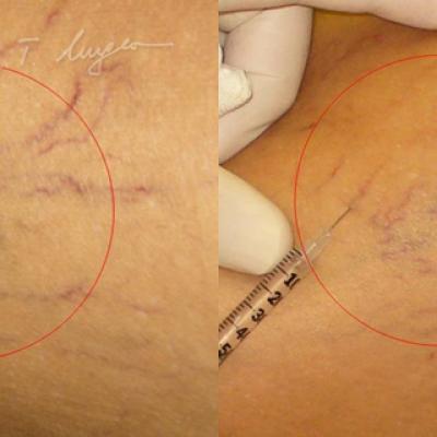 Venectazii Intradermice Injectarea De Solutii Sclerozante 2