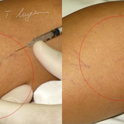 Venectazii Intradermice Injectarea De Solutii Sclerozante 3