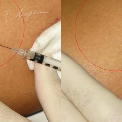 Venectazii Intradermice Injectarea De Solutii Sclerozante