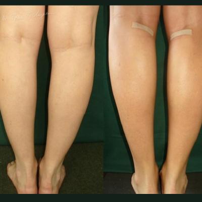 1 Implant Gambe Silicon