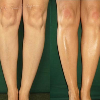 Implant Gambe Cu Silicon