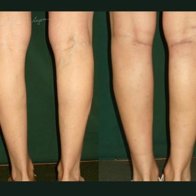 Implant Gambe Silicon 1