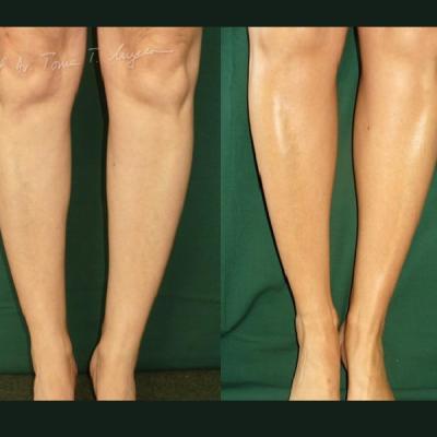 Implant Gambe Silicon 2