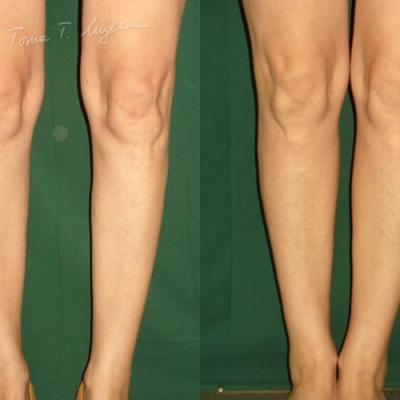 Implant Gambe Silicon 4