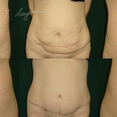 Abdominoplastie 2