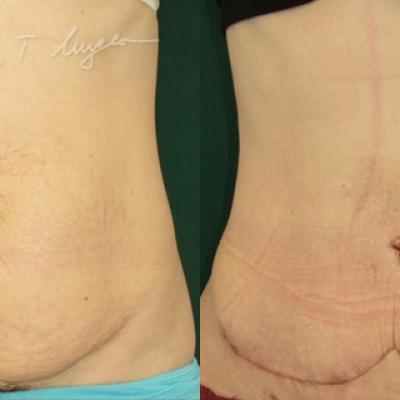 Abdominoplastie Cu Plicatura Aponevrozei Dreptilor Abdominali 1 2