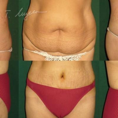 Abdominoplastie Cu Plicatura Aponevrozei Dreptilor Abdominali 2