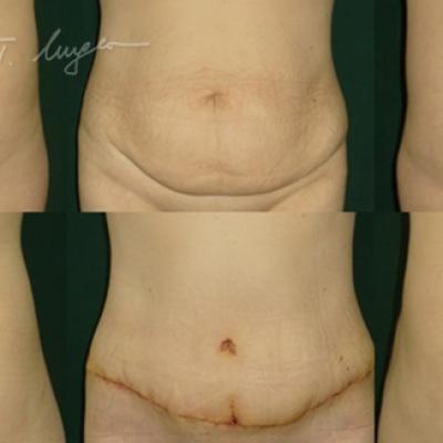 Abdominoplastie Cu Plicatura Aponevrozei Dreptilor Abdominali