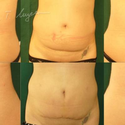 Lipoaspiratie Cu Miniabdominoplastie 2