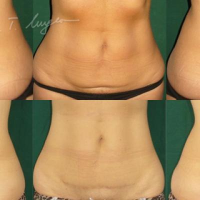 Miniabdominoplastie 1 2