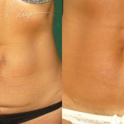 Miniabdominoplastie 2 2