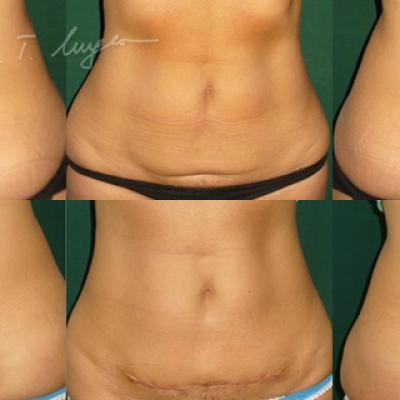Miniabdominoplastie 2