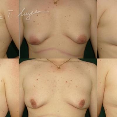 Lipoaspiratie 1