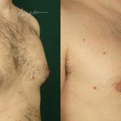 Lipoaspiratie Si Mastectomie Subcutanata 1