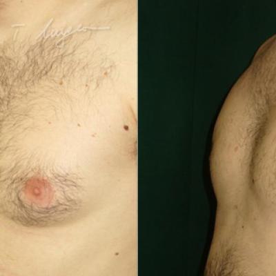 Lipoaspiratie Si Mastectomie Subcutanata 2