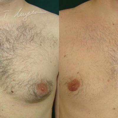 Lipoaspiratie Si Mastectomie Subcutanata
