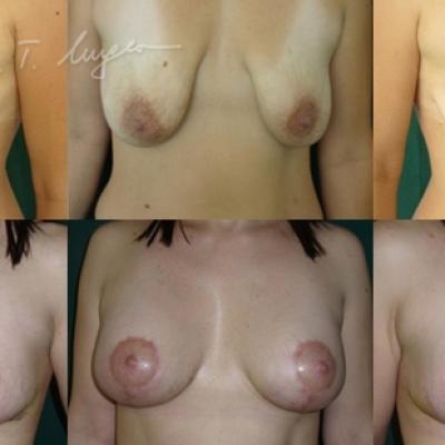 Mastopexie Si Implant Mamar 1