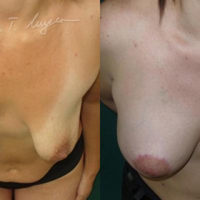 Mastopexie Si Implant Mamar In 2 Timpi 1