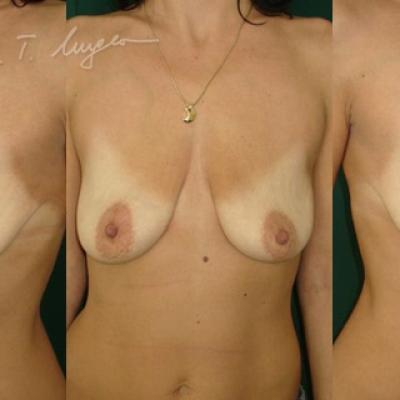 Ptoza Mamara Tip 0 Mastopexie Si Implant Mamar Simultan 1